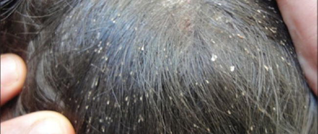 ¿Qué significa soñar que mi hija se llena de piojos?