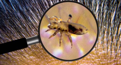 soñar con muchos piojos en la cabeza de un niño