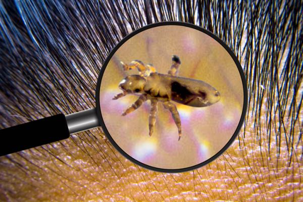 soñar con piojo en la cabeza de otra persona