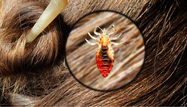 ¿Por qué se tienen piojos?