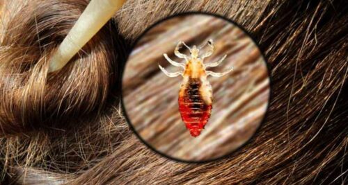 soñar con piojos en la cabeza de otra persona