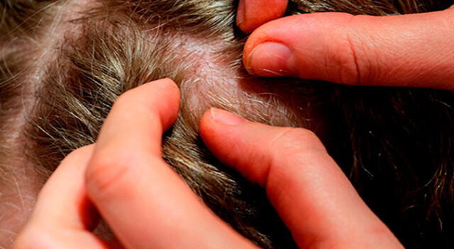 ¿Qué significan los piojos en un sueño?