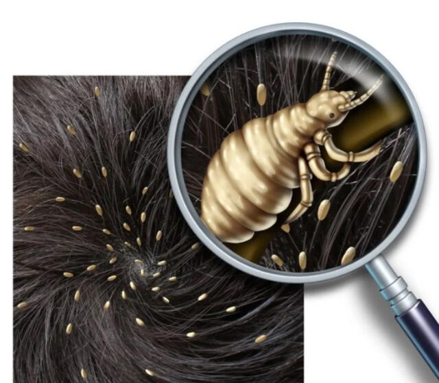 ¿Qué significa soñar con piojos y que uno los mata?