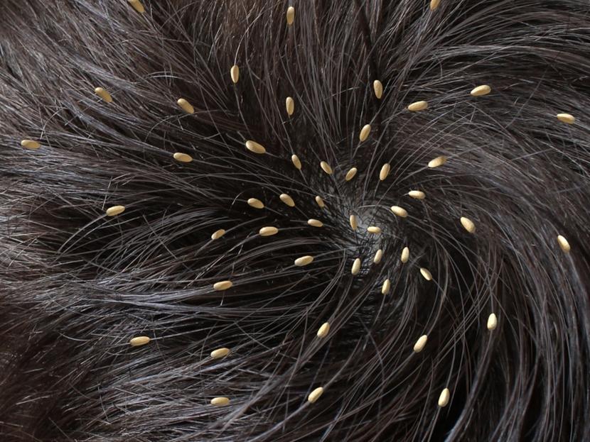 ¿Qué significa soñar con muchos piojos vivos?