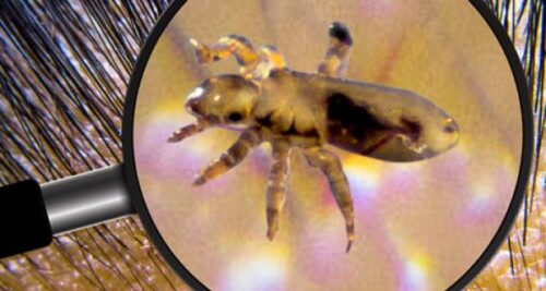 soñar con piojos y matarlos en otra persona