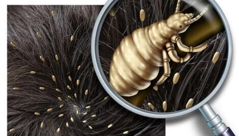 soñar con un piojo negro y grande